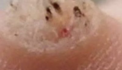 6 Types of Warts (Signs, Symptoms, Home Remedies, and Treatment)…