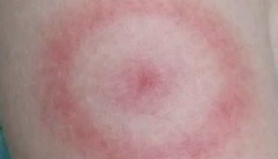 My daughter woke up with this strange red ring on her arm. It’s not itchy but looks spreading. I’m panicking, do I need to rush her in?