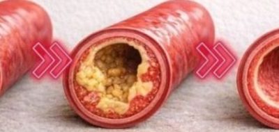 Say goodbye to blocked arteries with these powerful foods