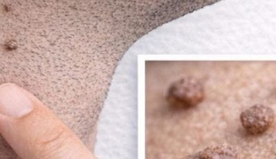 Banana Peel and Other Natural Ingredients for Wart Care