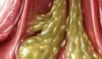 The Correct Method to Eliminate Mucus and Phlegm from the Throat and Lungs