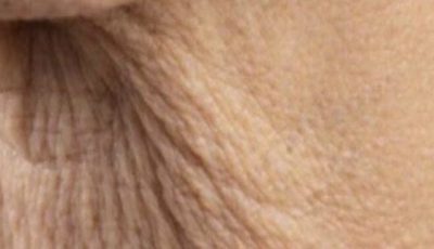 Why does neck skin sag with age — and what can be done about it?