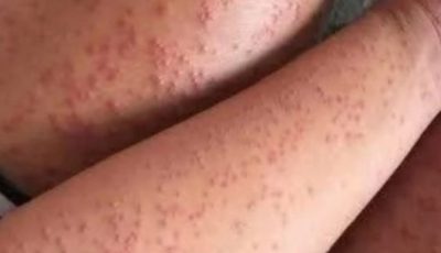 Skin Rash With Breathing Trouble? It Could Be a Life-Threatening Allergic Reaction